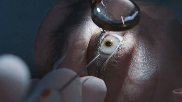 Cataract Surgery for Better Vision Health